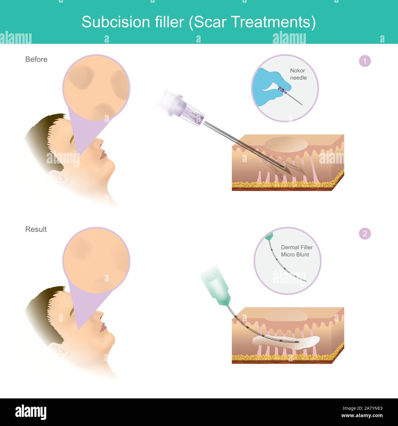 Trattamenti di cicatrice. Illustrazione di spiegare un trattamento che comporta il taglio dei filamenti di recise bande fibrose tessuto cicatriziale sotto strati di pelle e INJ Illustrazione Vettoriale