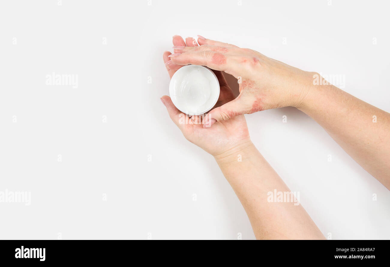 Crema per il trattamento di dermatite. Mani femminili, close-up. Lay piatto  Foto stock - Alamy
