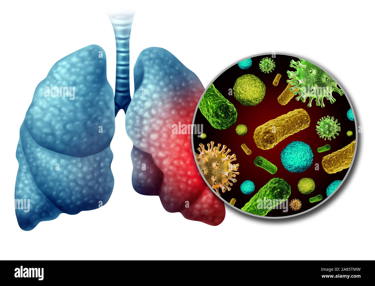 La polmonite infezione anatomia come un concetto medico come l'infiammazione dei polmoni umani infettati dal virus e batteri come una malattia polmonare diagnosi. Foto Stock La polmonite infezione anatomia come un concetto medico come l'infiammazione dei polmoni umani infettati dal virus e batteri come una malattia polmonare diagnosi. Foto Stock
