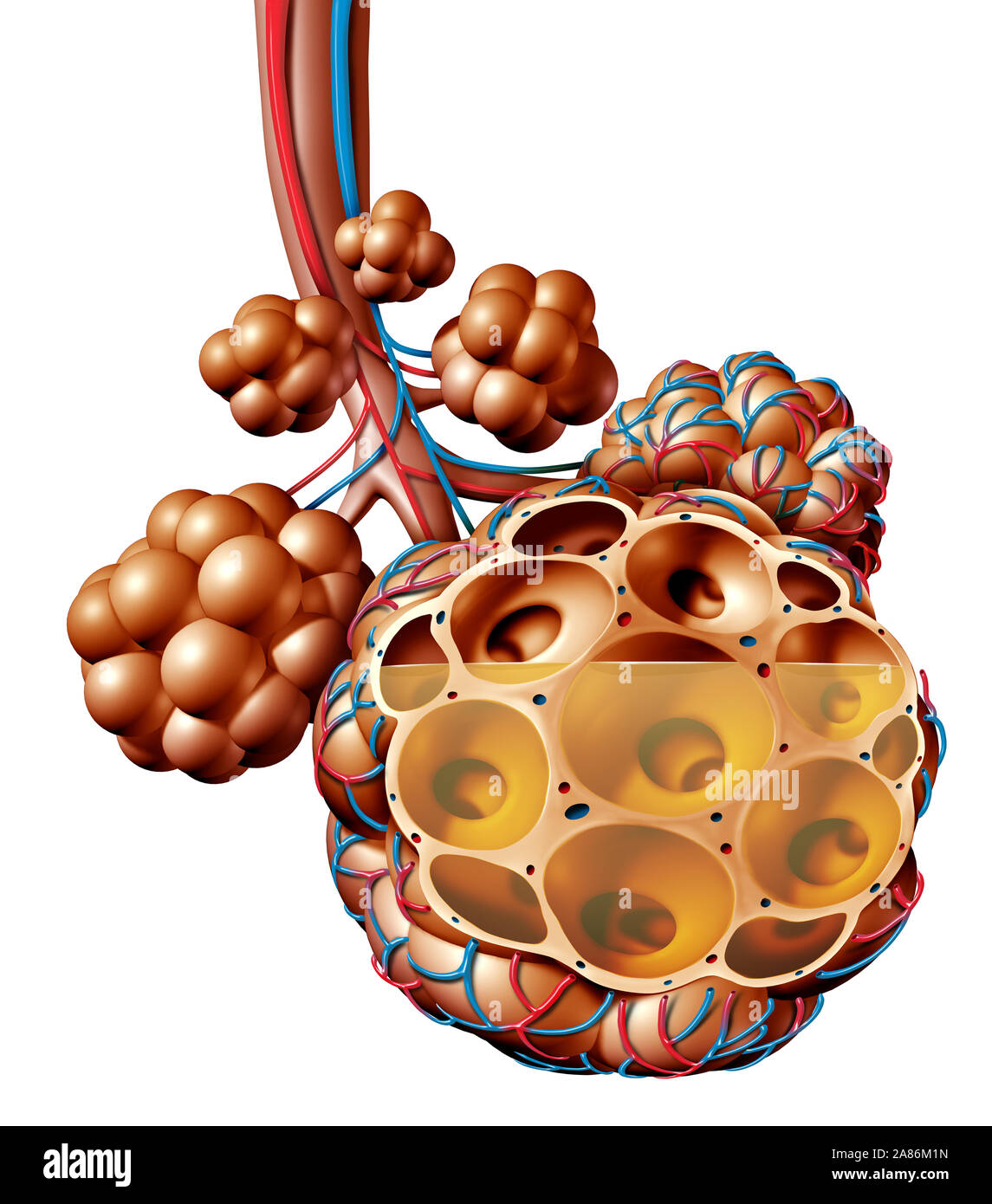 La polmonite e alveoli polmonari con fluido o alveolo infiammazione anatomia diagramma come un concetto medico di anatomia del polmone e delle vie respiratorie. Foto Stock