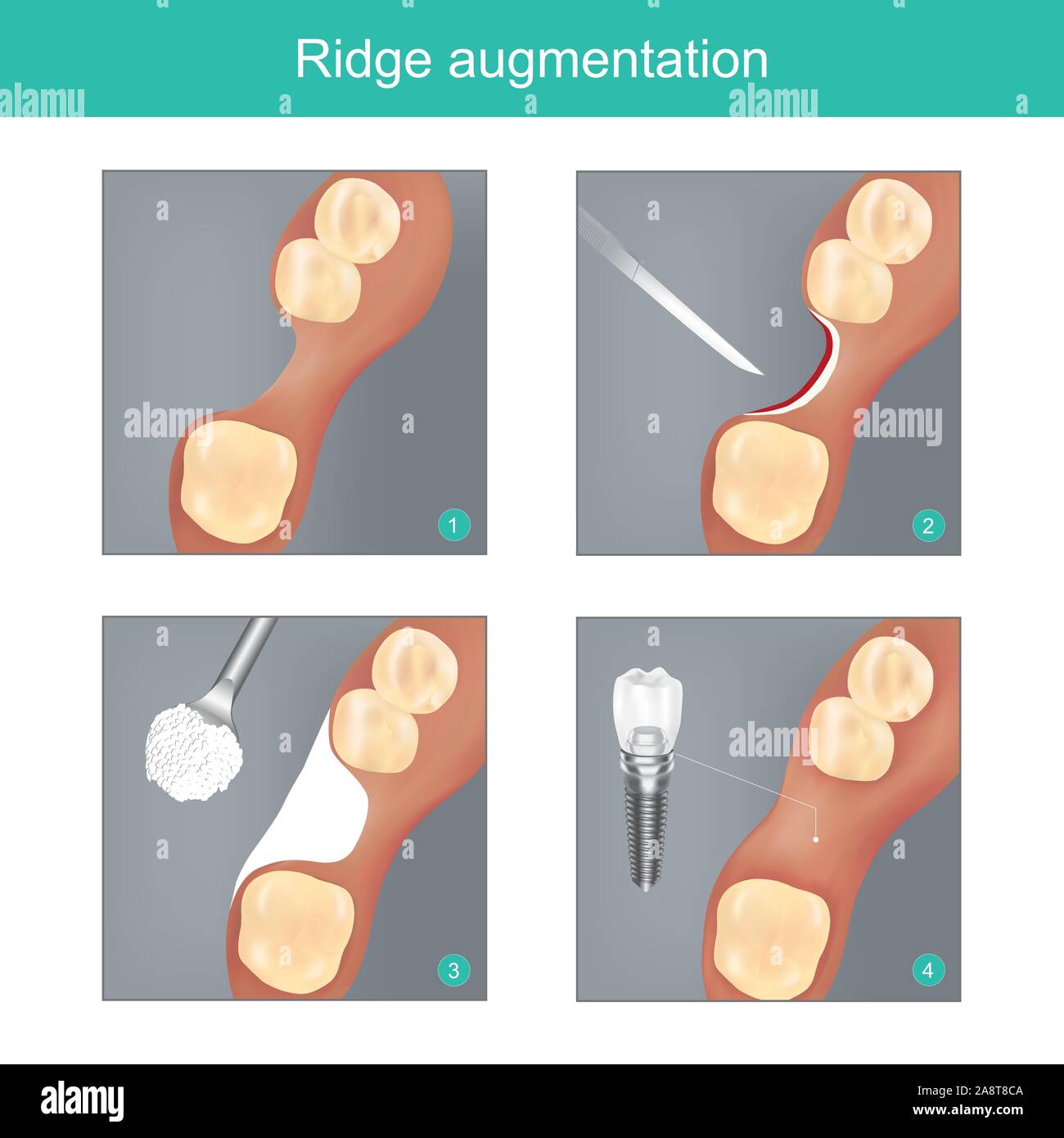 Ridge augmentation. Il metodo usato dentale materiali sintetici o osso umano per sostituire la mandibola in mancante e per preparare un impianto dentale per lavoro Illustrazione Vettoriale