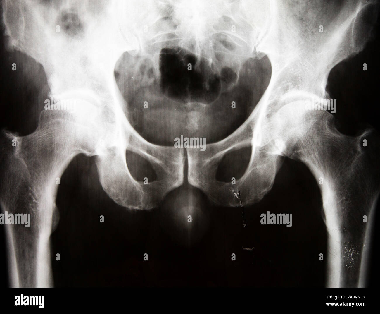 I raggi X di un bacino umano Foto Stock