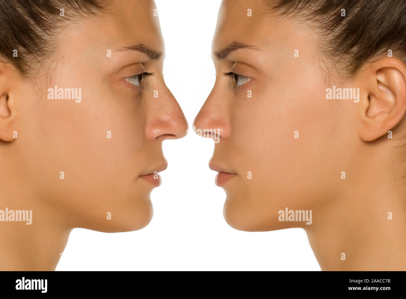 Beuatifull giovane donna prima e dopo la chirurgia del naso Foto Stock