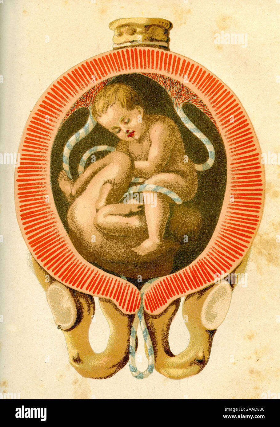 I gemelli in utero. Firma originale: "Rare e posizione irregolare di una gemella di frutta in utero che richiedono la nascita artificiale'. , (Libro medicinali, ca. 1900) Foto Stock