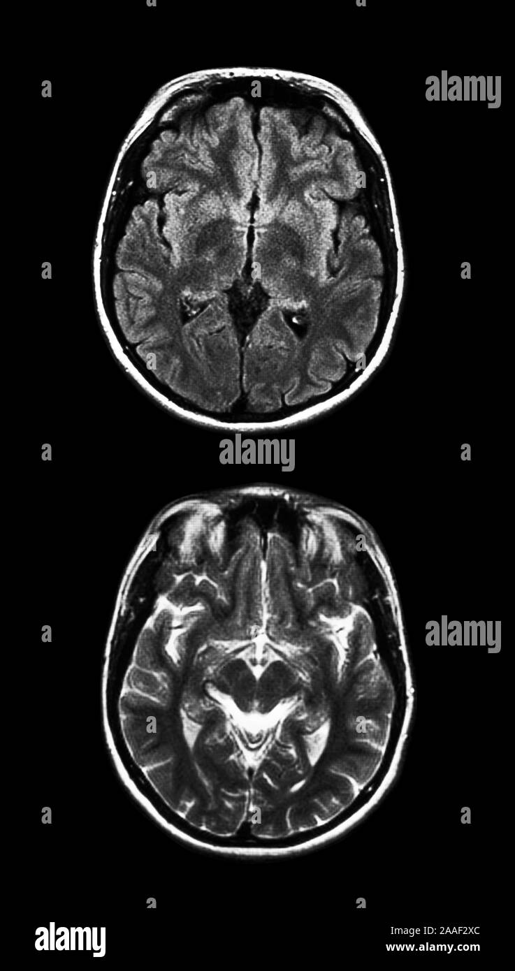 Brain MRI scan sul nero Foto Stock