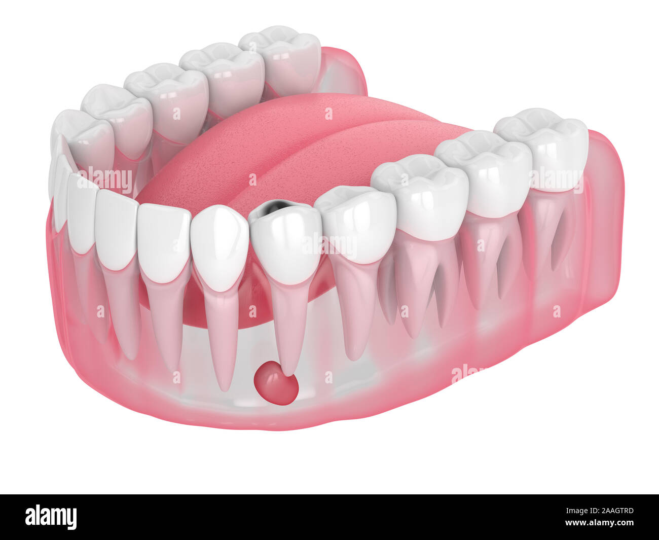 3D render della ganascia con cavità del dente e cisti. Problema dentale concetto. Foto Stock