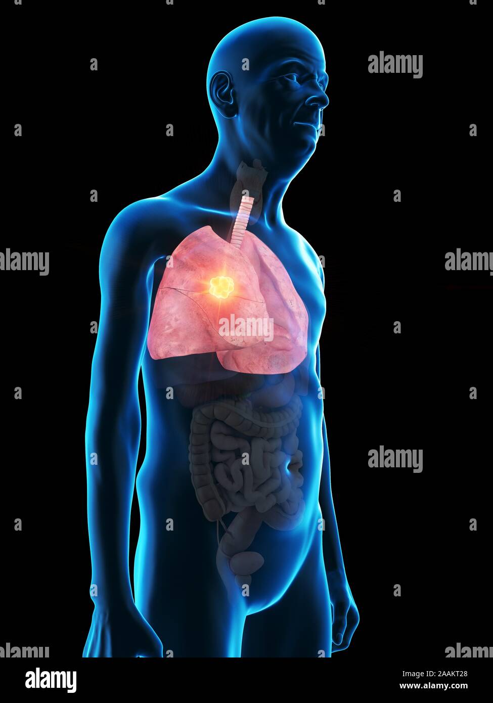 Illustrazione di un vecchio uomo di tumore ai polmoni. Foto Stock