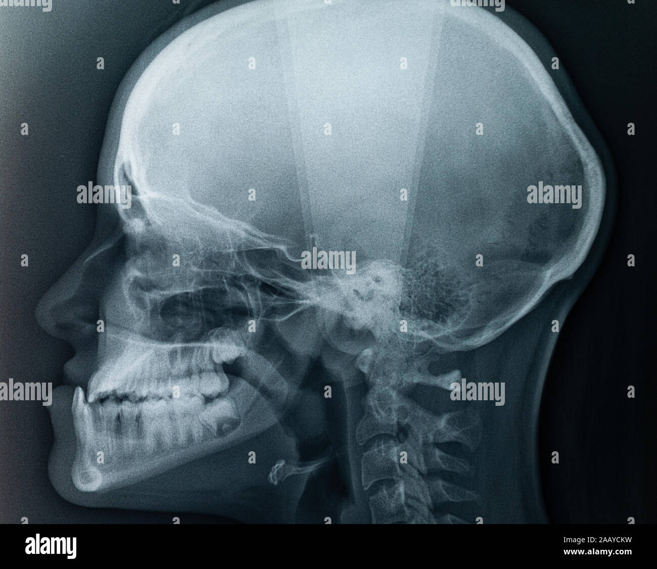 Raggi x di una testa,cranio x-ray.Vista laterale. Foto Stock