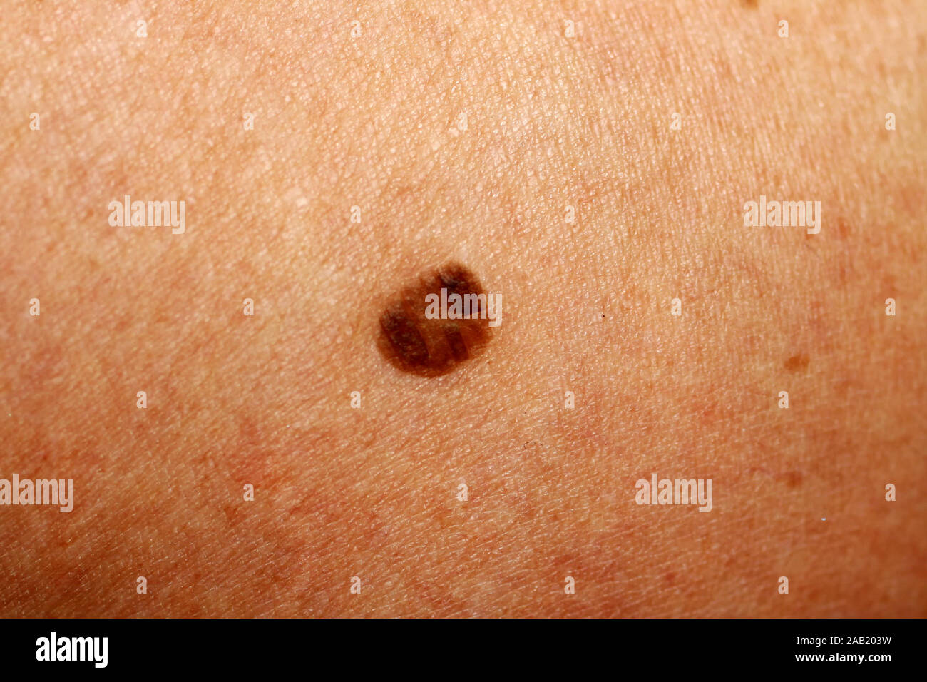 Macchia marrone scuro sulla pelle. Birthmark sul corpo Foto stock - Alamy