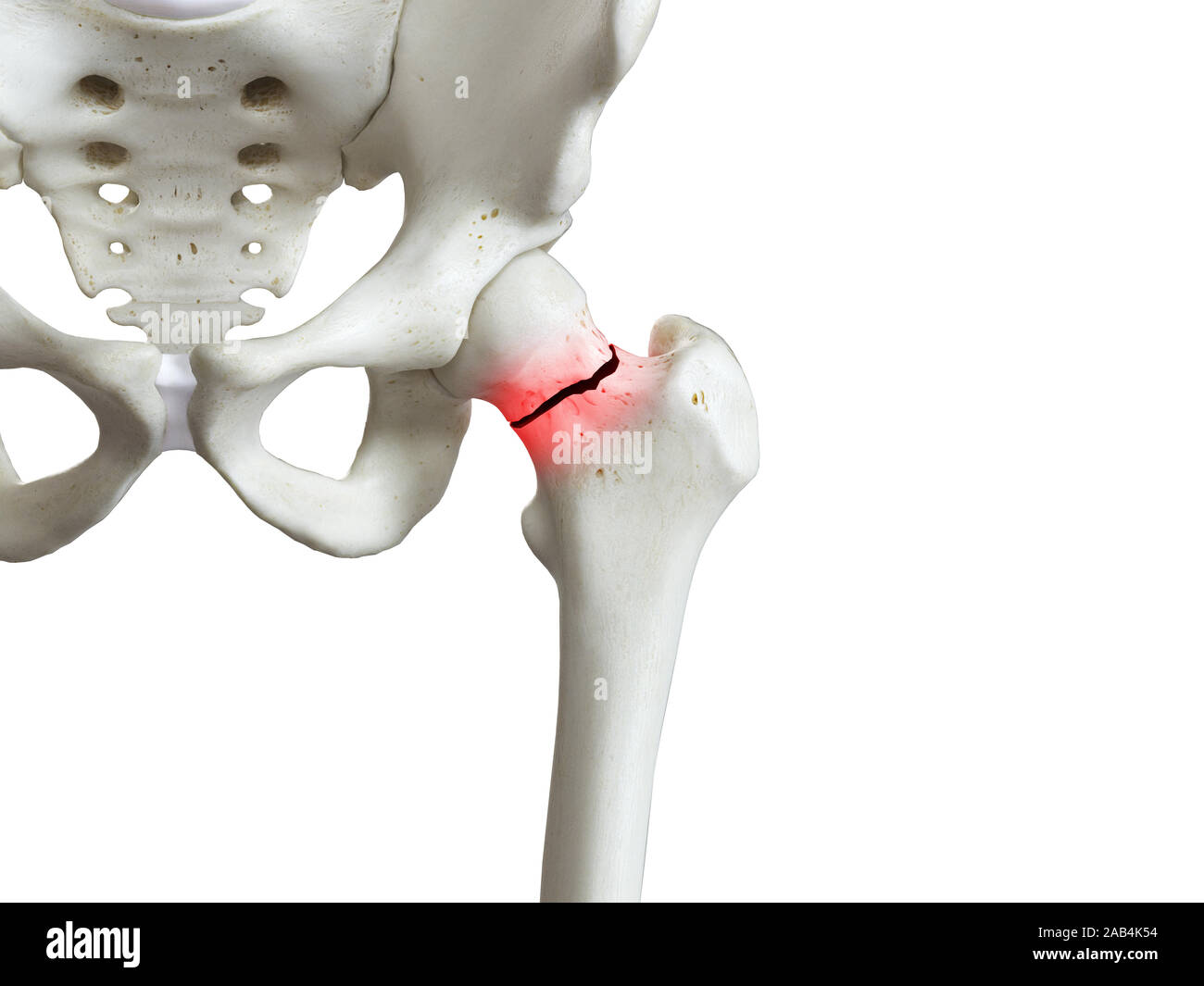 3D Rendering accurato dal punto di vista medico illustrazione di un femore rotto il collo Foto Stock