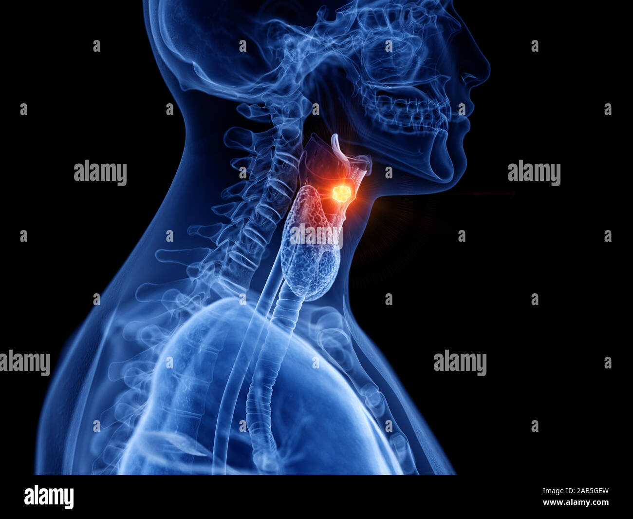 3D Rendering accurato dal punto di vista medico illustrazione del cancro della laringe Foto Stock