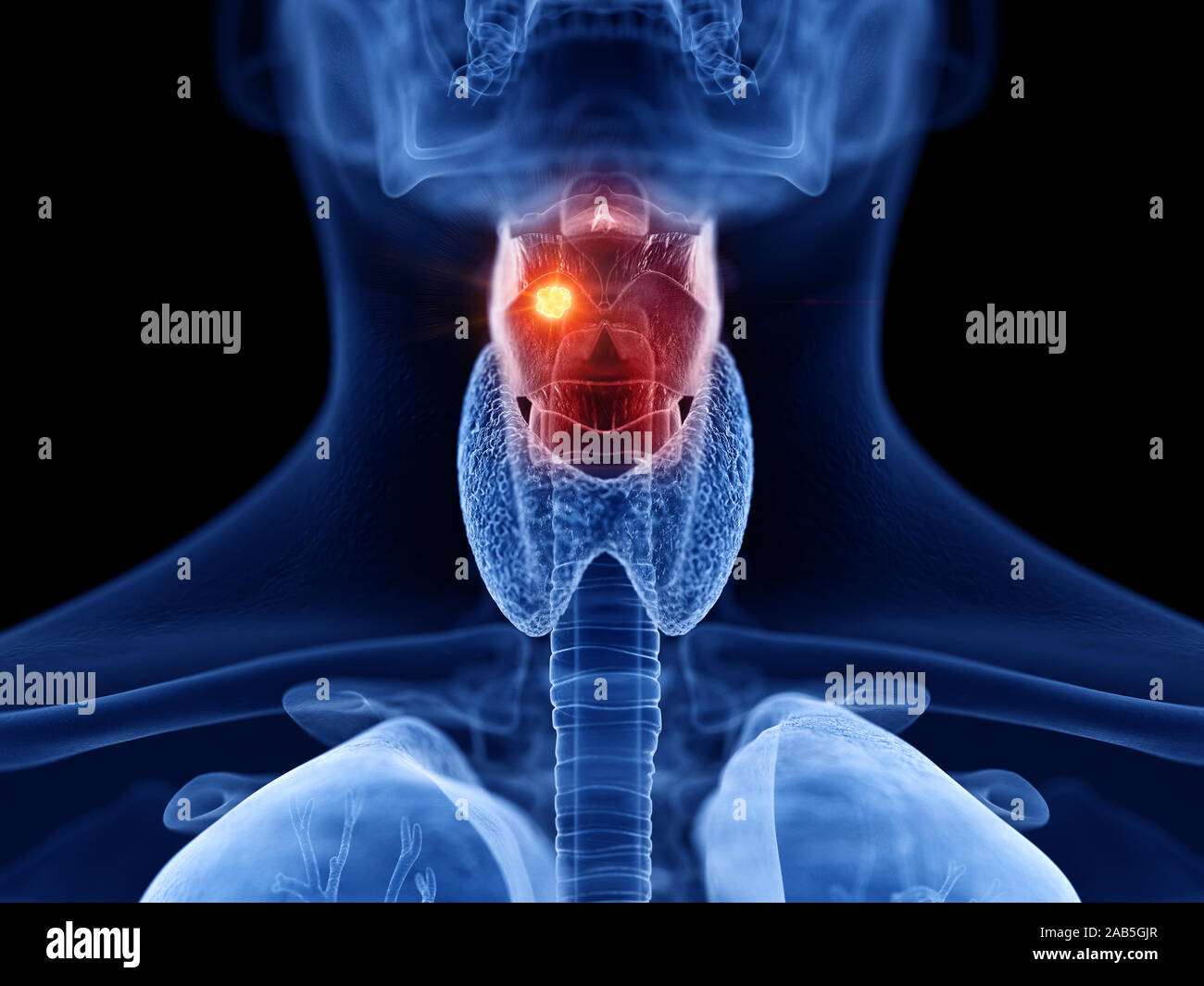 3D Rendering accurato dal punto di vista medico illustrazione del cancro della laringe Foto Stock