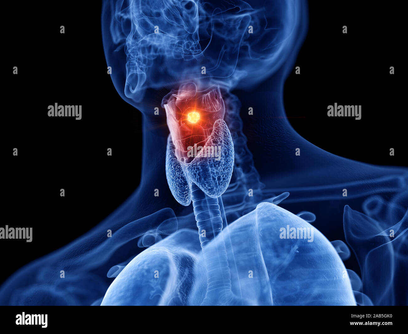 3D Rendering accurato dal punto di vista medico illustrazione del cancro della laringe Foto Stock