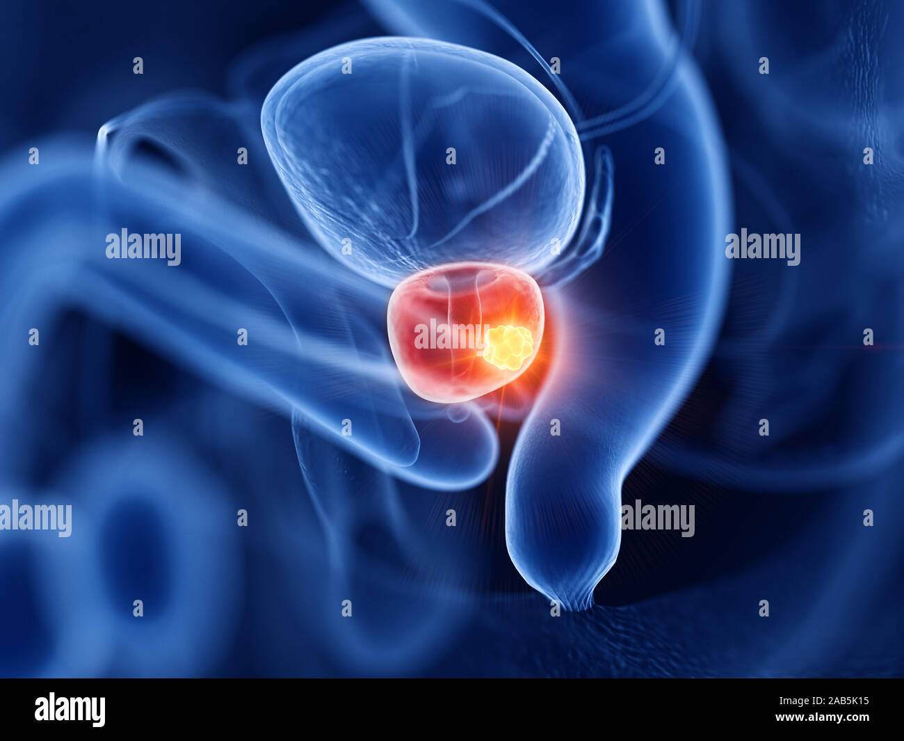 3D Rendering accurato dal punto di vista medico illustrazione del cancro della prostata Foto Stock