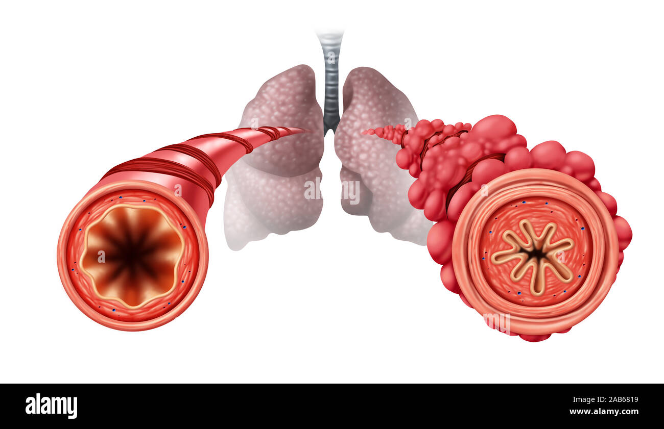 Popcorn condizione del polmone concetto o obliterative bronchiolitis malattia come ostruito tubi bronchiali strozzata causato da vaping muscolo respiratorio. Foto Stock