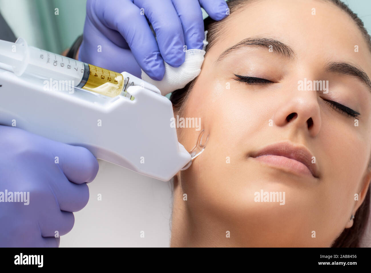 Terapista cicatrice rimozione con micro tecnologia di agugliatura. Non il trattamento chirurgico applicato sulla guancia femmina. Foto Stock