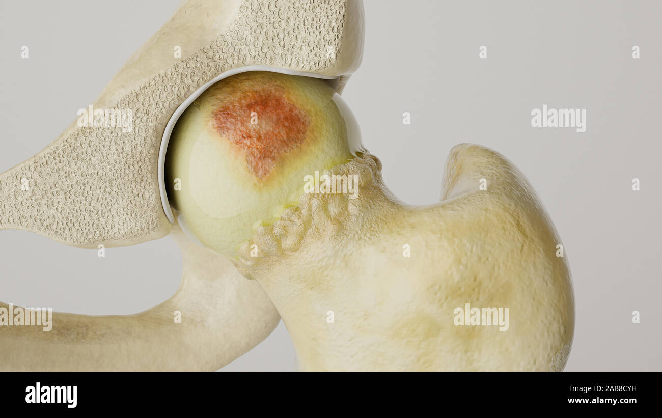 Artheritis più forte sull'anca - alto grado di dettaglio - il rendering 3D Foto Stock