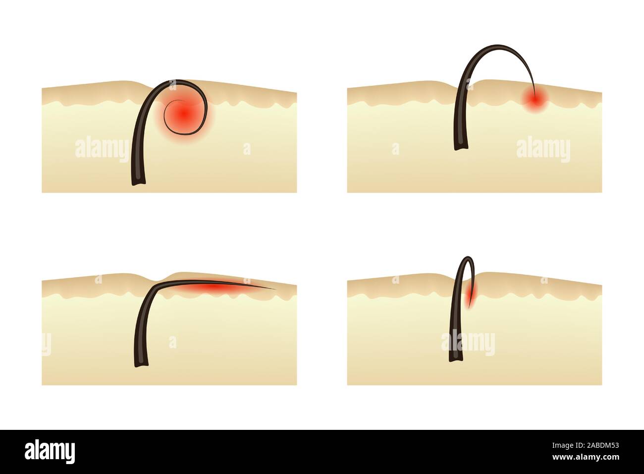 Il fenomeno dei peli incarniti dopo la depilazione. Illustrazione Vettoriale. Infiammazione della pelle dermatologia. Illustrazione Vettoriale