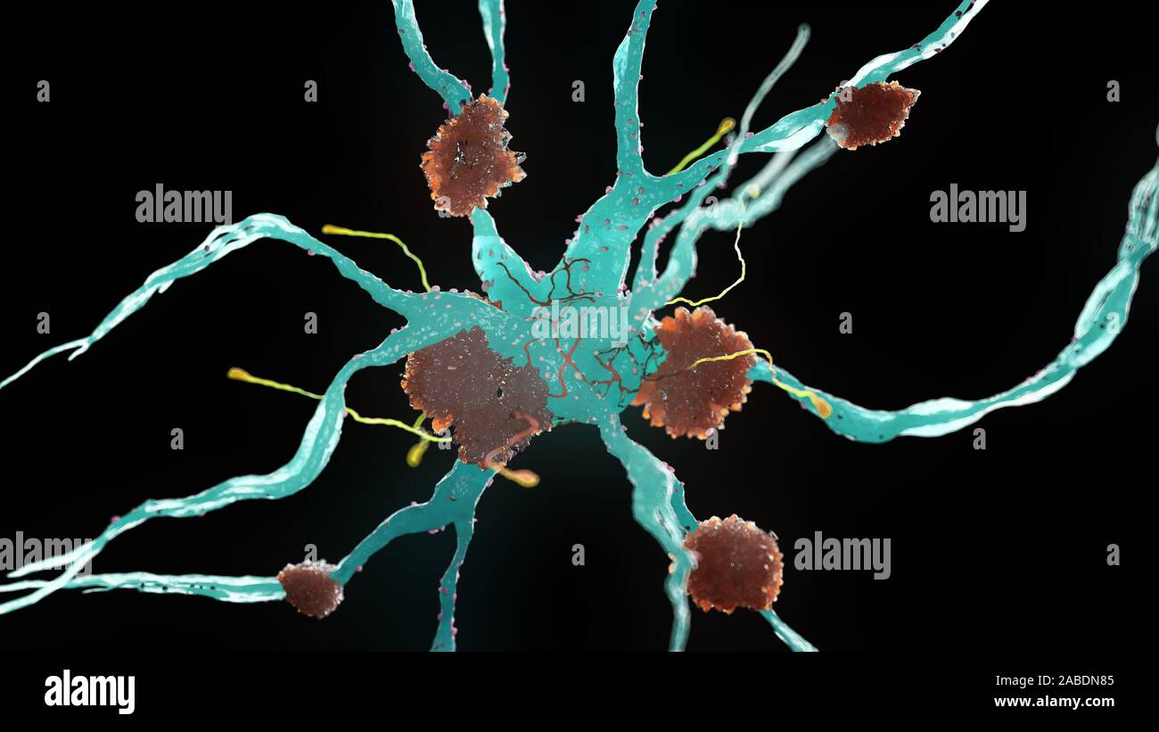 Rendering 3d Illustrazione medica di cellule nervose affette da malattia di Alzheimer Foto Stock