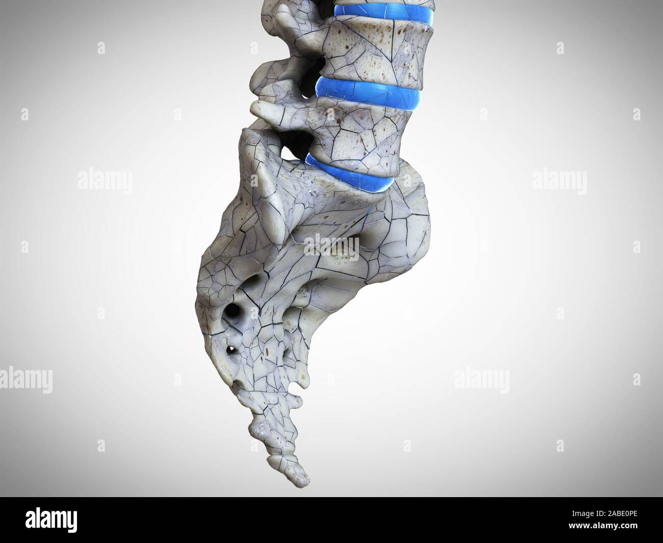 3D Rendering accurato dal punto di vista medico illustrazione di un dorso rotto Foto Stock