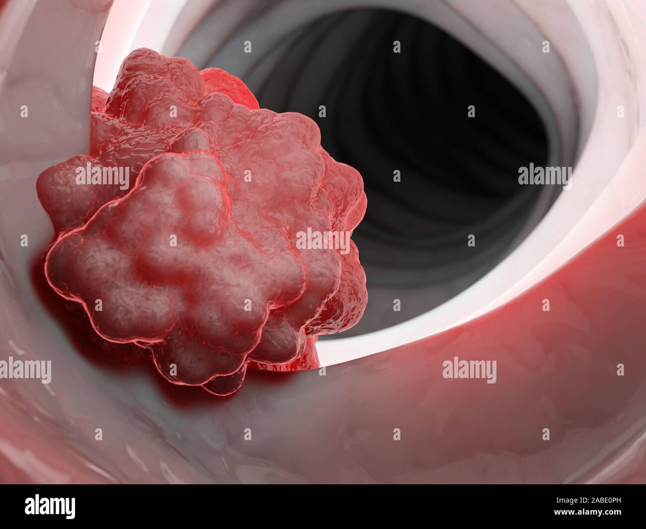 3D Rendering accurato dal punto di vista medico illustrazione di un tumore del colon Foto Stock