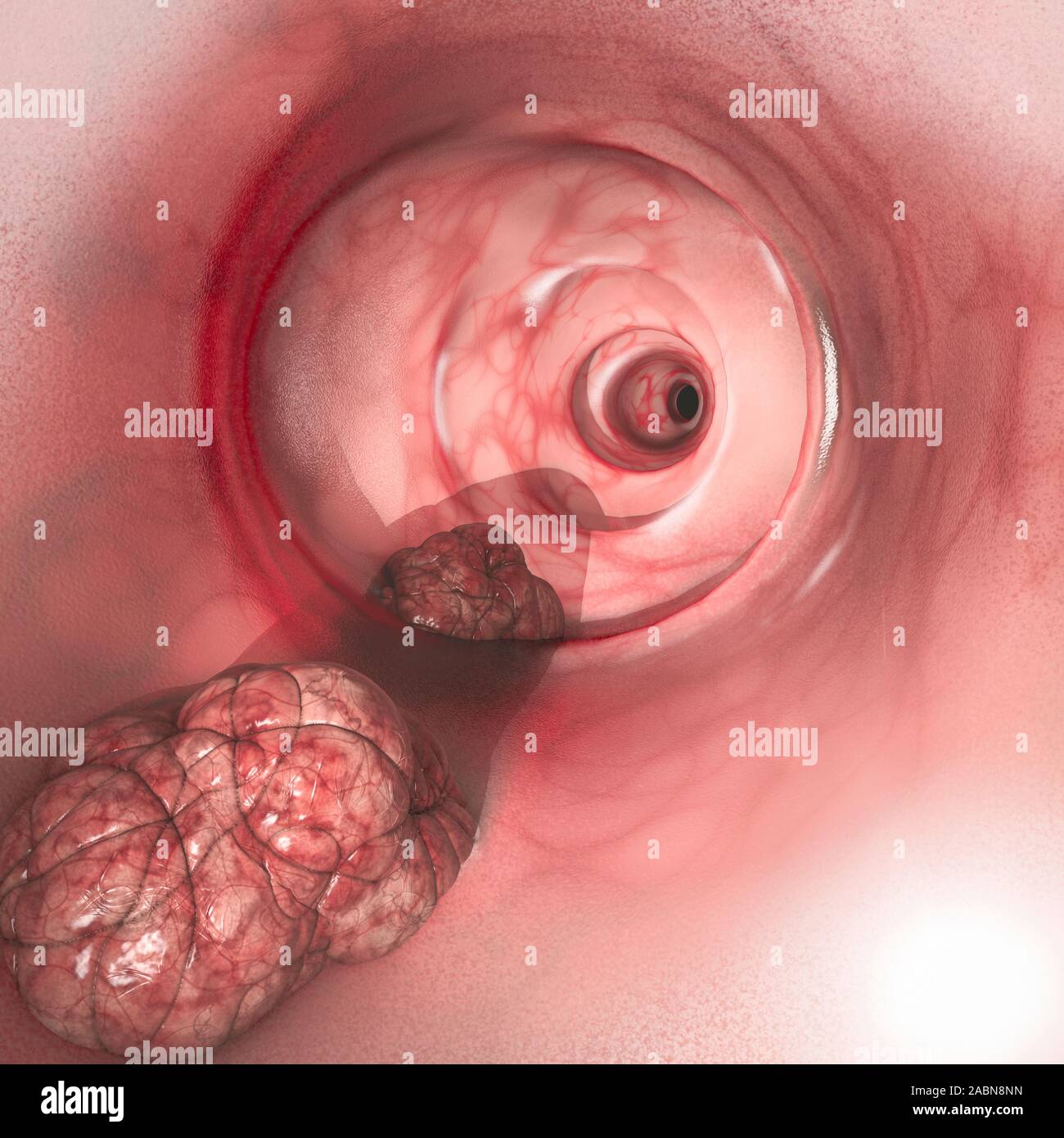 Vista interna delle pareti intestinali. Cancro colorettale (CRC), intestino cancro, il cancro del colon, cancro rettale o. Crescita anormale di cellule Foto Stock