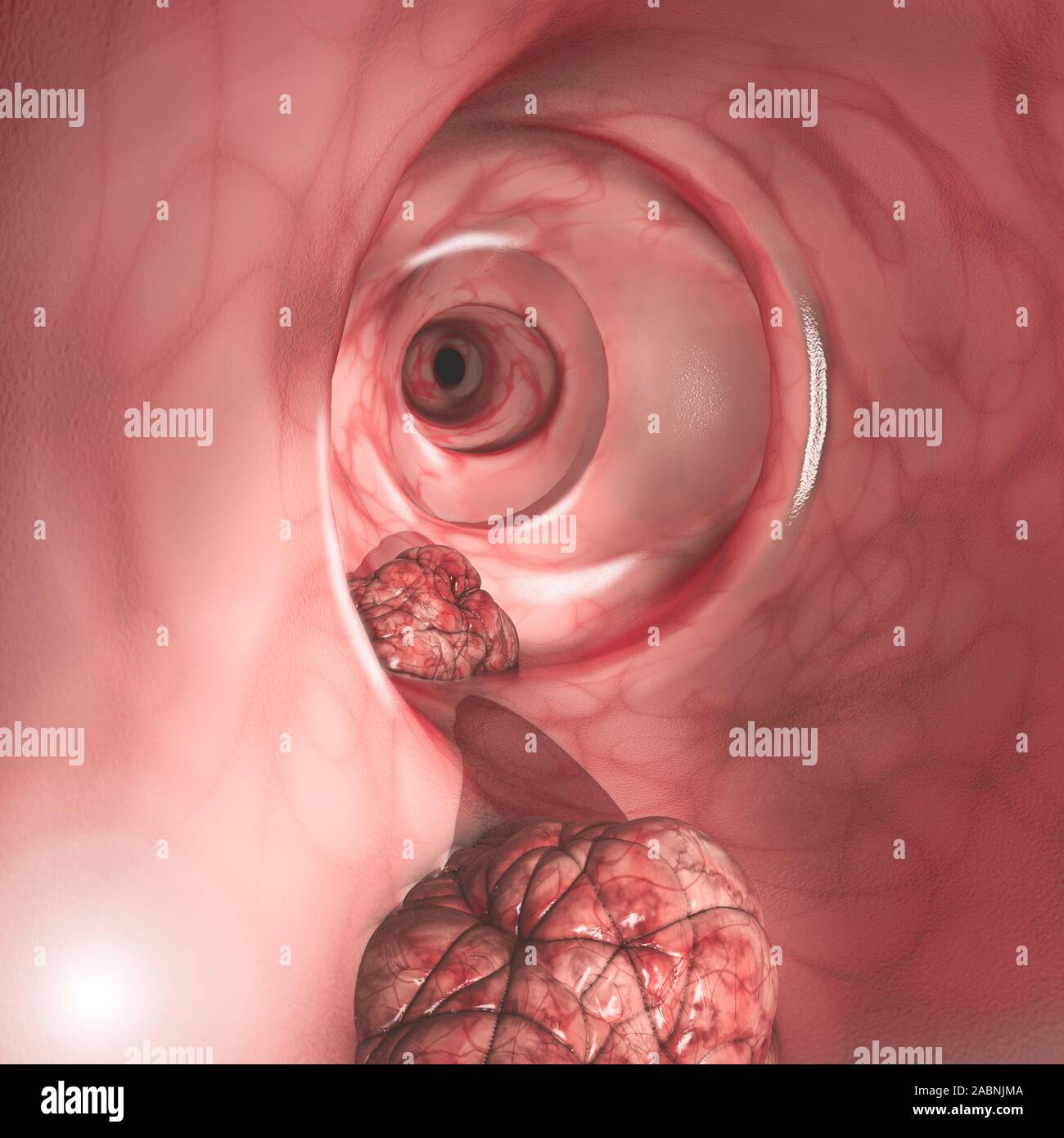 Vista interna delle pareti intestinali. Cancro colorettale (CRC), intestino cancro, il cancro del colon, cancro rettale o. Crescita anormale di cellule Foto Stock