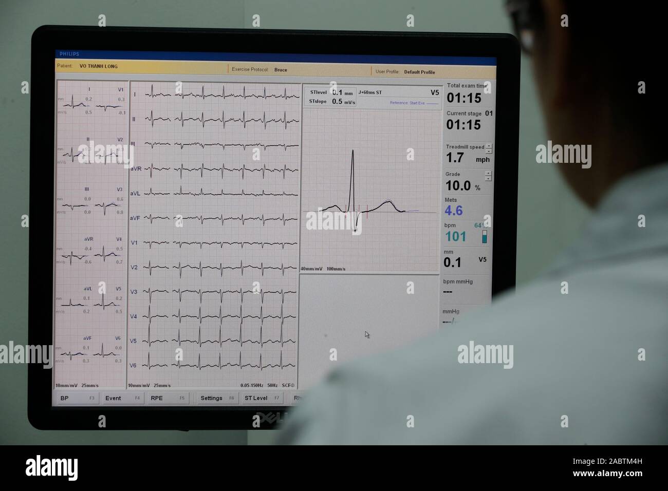 Prova di cardiologia. Esercizio ECG. Ospedale. Elettrocardiogramma. Cardiologia. Ho Chi Minh City. Il Vietnam. Foto Stock