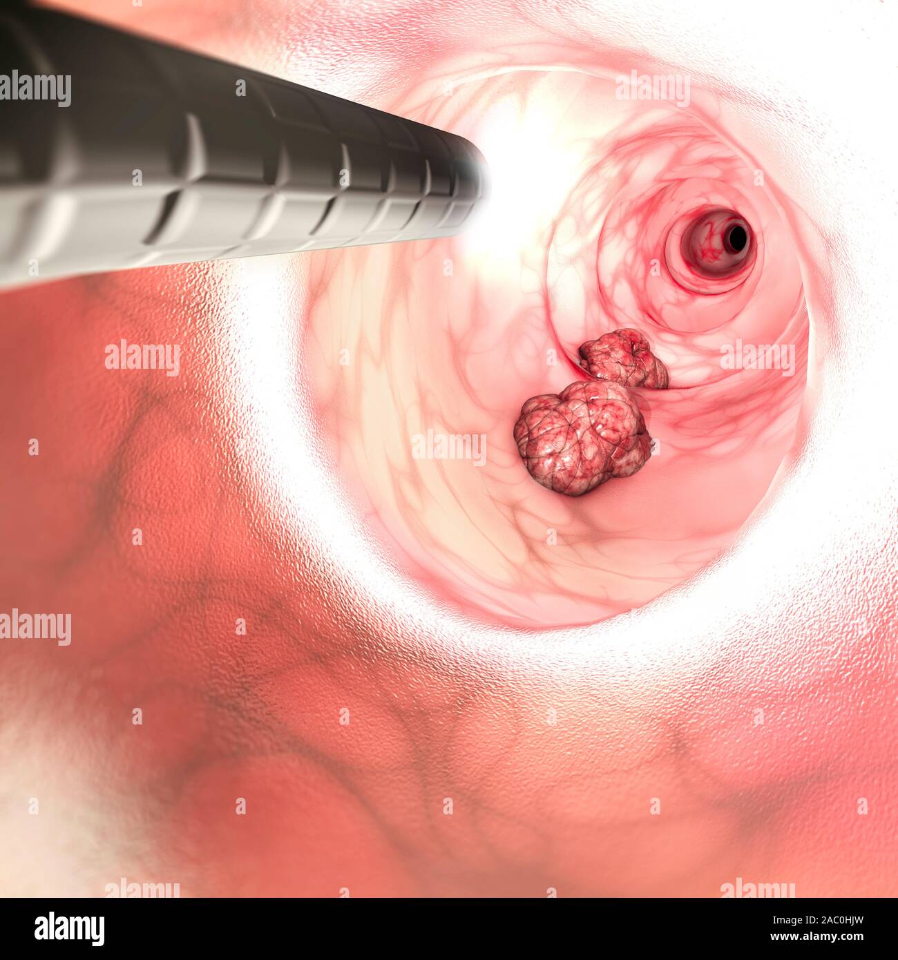 Vista interna delle pareti intestinali. Cancro colorettale (CRC), intestino cancro, il cancro del colon, cancro rettale o. Crescita anormale di cellule Foto Stock