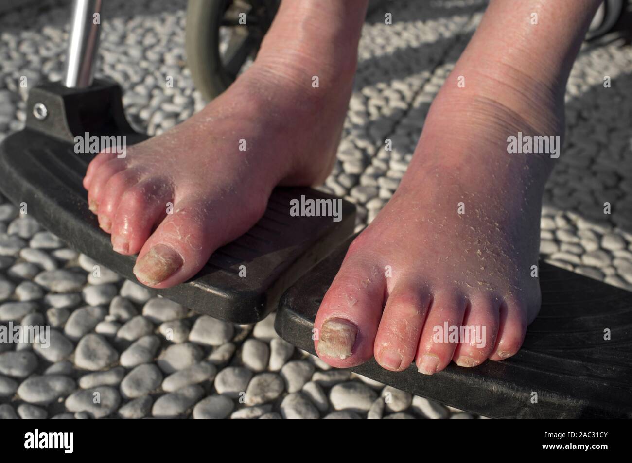 Anziani piedi gonfi con infezione fungina in carrozzina Foto Stock