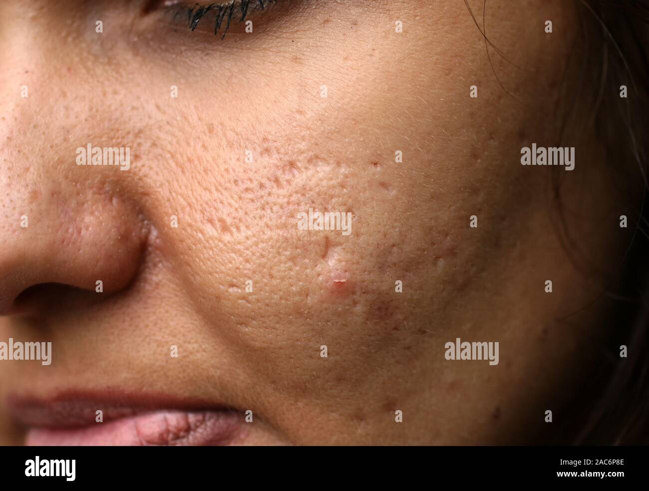 Ha infiammato la pelle del viso. L'Acne. Brufoli sulla pelle. Cicatrici e peeling. Foto Stock