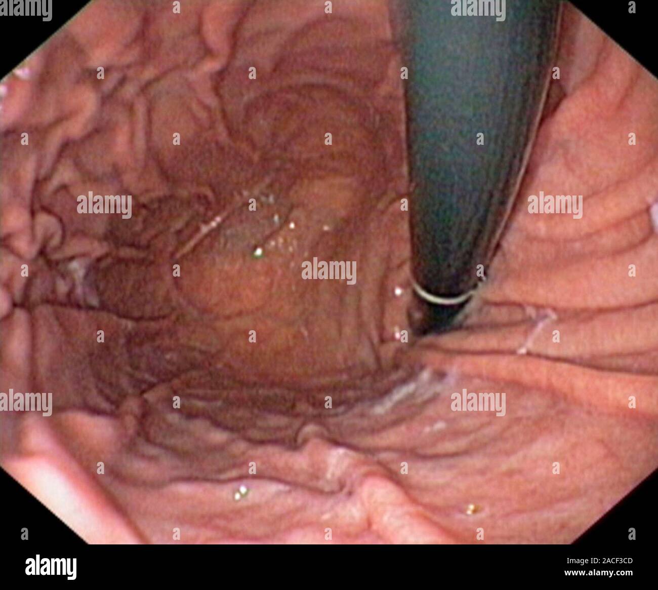 Lo stomaco sano. Visualizzazione endoscopica della sezione sinistra (fondo gastrico) di un normale dello stomaco, che mostra la caratteristica creste (gastrica di pieghe o pliche Foto Stock