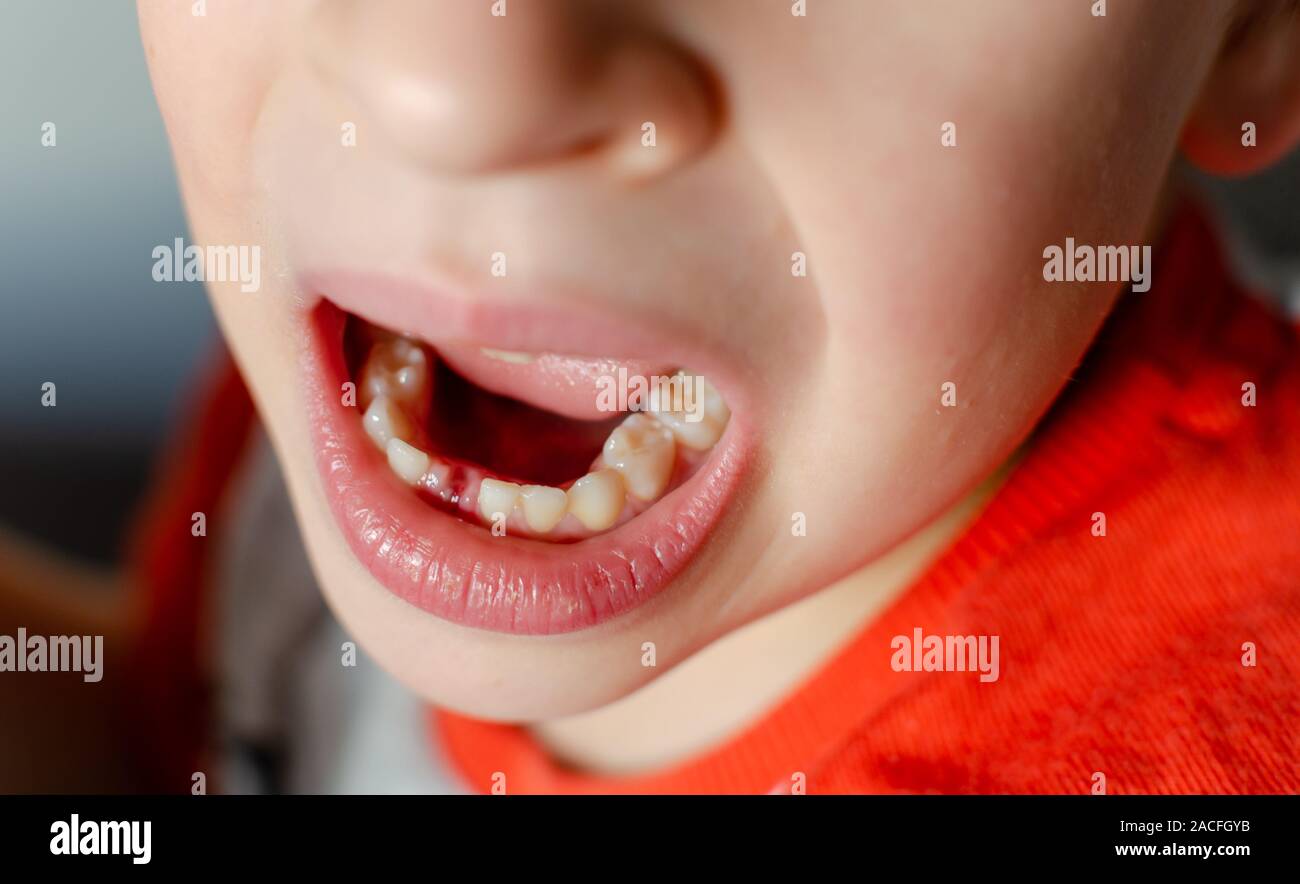 Il ragazzo, un bambino ha perso un dente di latte, il foro, igiene orale concetto. Foto Stock