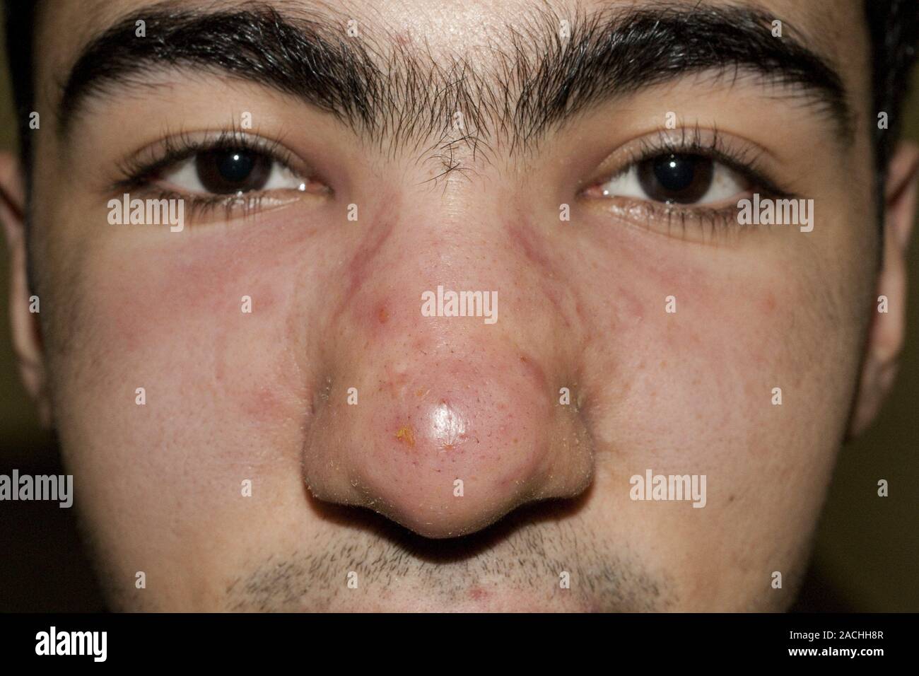 Acne cistica. Il rigonfiamento del naso e la zona circostante a causa di  acne cistica. L'acne è un nome generico dato ad un disturbo della pelle in  cui le ghiandole sebacee glan