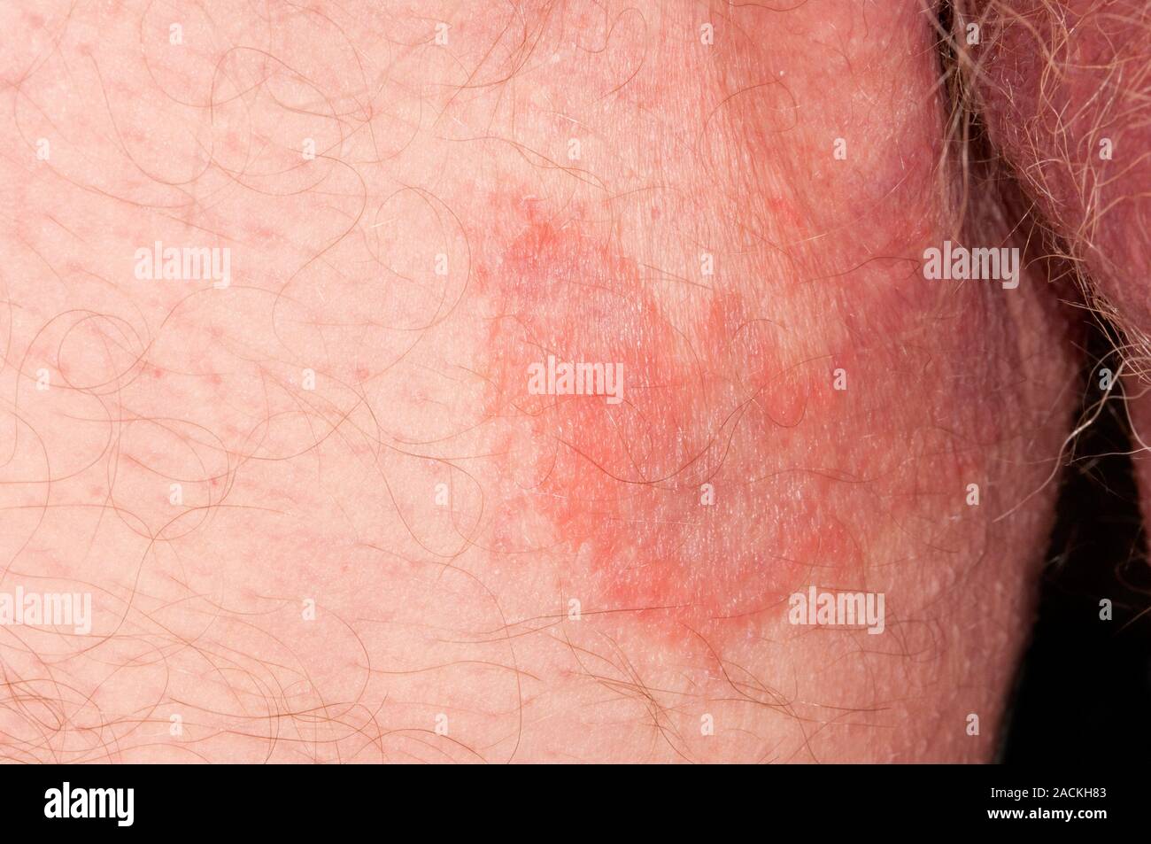 Tigna infezioni fungine sulla pelle dell'inguine (zona inguinale) in 79  anni di paziente di sesso maschile. Noto come tinea cruris o Jock prurito,  può essere causa di Foto stock - Alamy