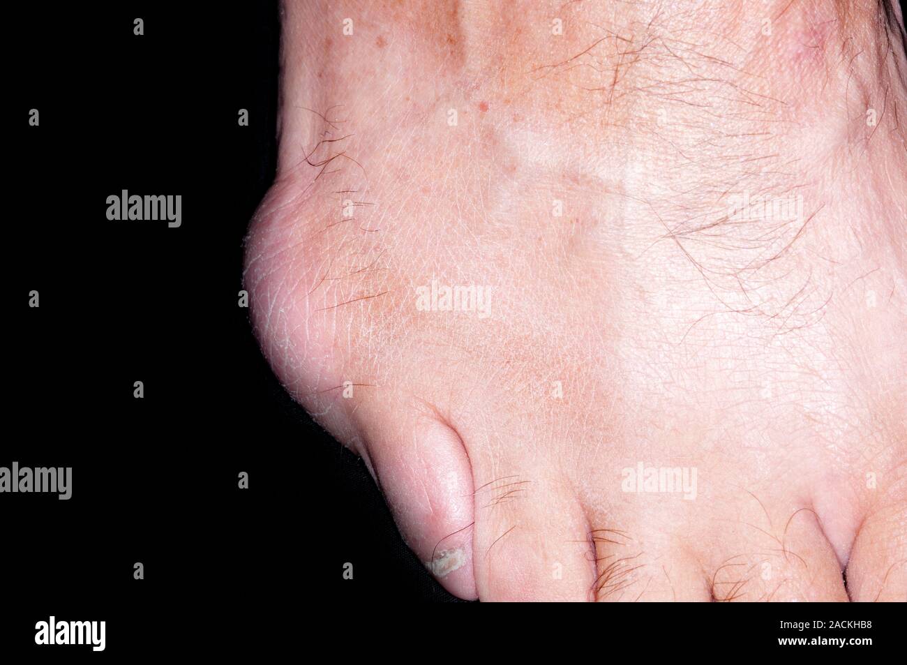 Rosso e gonfio metatarso-falangea del quinto dito del piede in un 61 anni,  paziente di sesso maschile causata da borsite (infiammazione delle  articolazioni). A Bursa è un tampone t Foto stock -