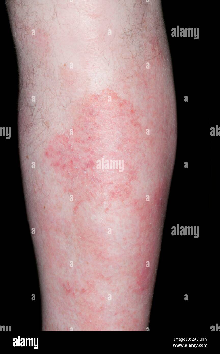 Patch rosso sulla pelle della gamba in una 66 anno vecchio paziente di sesso maschile con micosi fungoide. Micosi fungoide è un tipo di linfoma non-Hodgkin, un raro Foto Stock