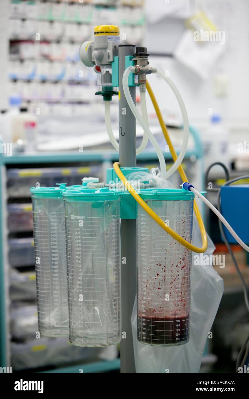 Aspirazione chirurgica macchina contenente il sangue dopo un intervento chirurgico su un paziente in un ospedale di teatro operativo. Foto Stock