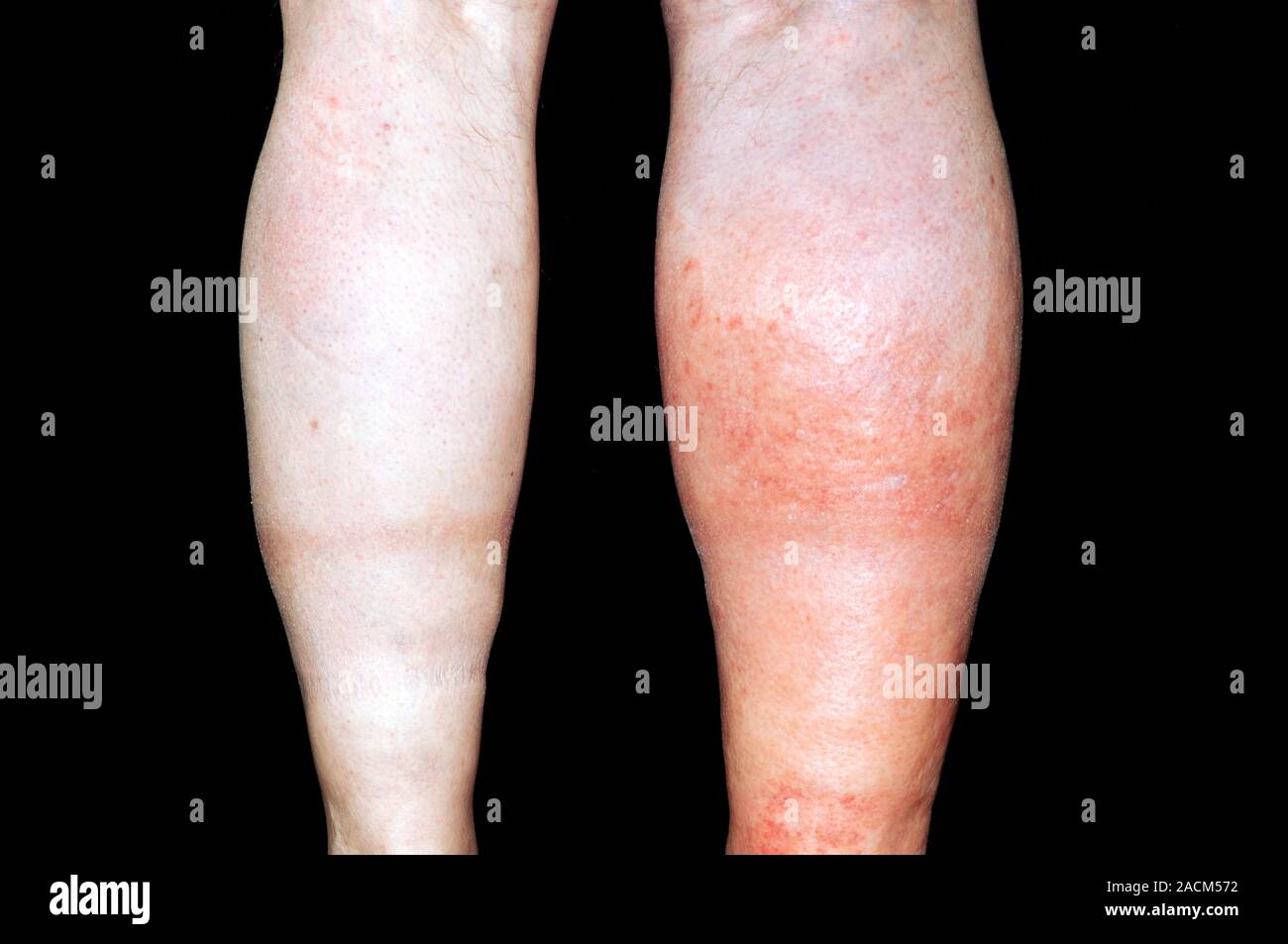 Rosso e gamba infiammato (a destra) in 61 anni, paziente di sesso maschile a causa di trombosi venosa profonda (DVT). La TVP è la formazione di un coagulo (trombosi) all'interno de Foto Stock