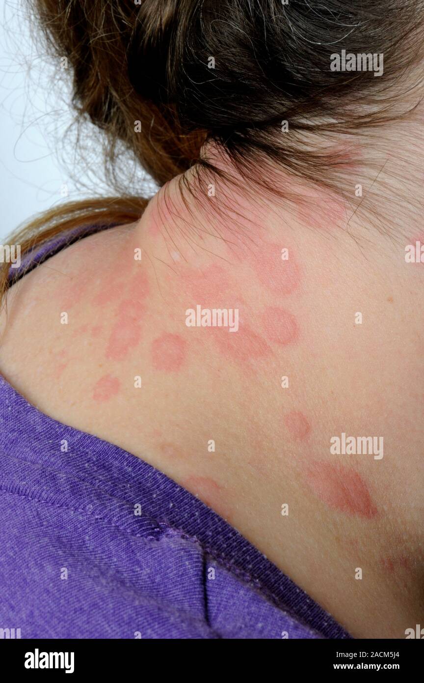 Da non utilizzare in televisione non per uso in televisione di close-up di  rosso di ponfi orticaria (orticaria o orticaria) sulla pelle del collo in  un adulto fem Foto stock - Alamy