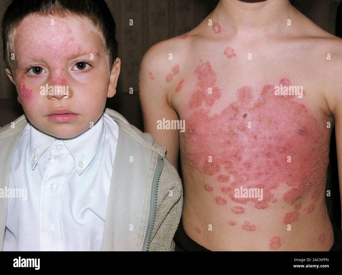 Patch rosso sulla pelle del viso di un giovane ragazzo (a sinistra) e sul torace e addome di sua sorella maggiore a causa di infezione fungina. Noto come tinea Foto Stock