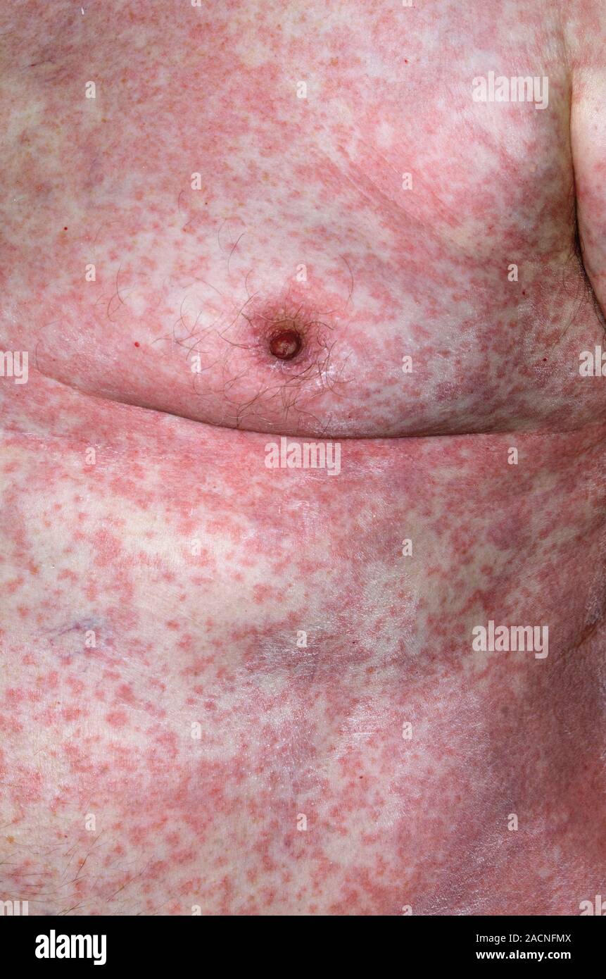 Eruzione cutanea rossa sulla pelle del corpo in un 73 anno vecchio paziente  di sesso maschile a causa di una reazione allergica alla anti-droga di  coagulazione clopidogrel Foto stock - Alamy
