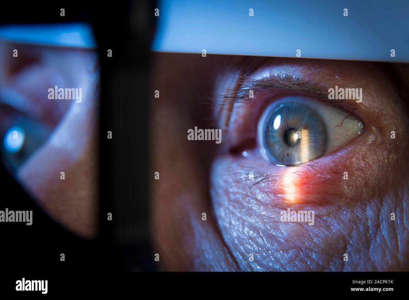 Lampada a fessura esame dell'occhio. Close-up di gli occhi di un paziente  sottoposto ad una lampada a fessura oftalmoscopio l'esame. Questo strumento  brilla un bel fascio di Foto stock - Alamy