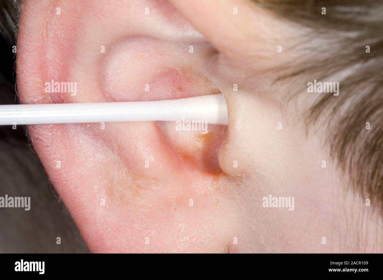 Close-up di pus lo scarico dal canale auricolare di un bambino di 2 anni  paziente di sesso maschile a causa di otite media con un timpano perforato.  L'otite media è una inflamma