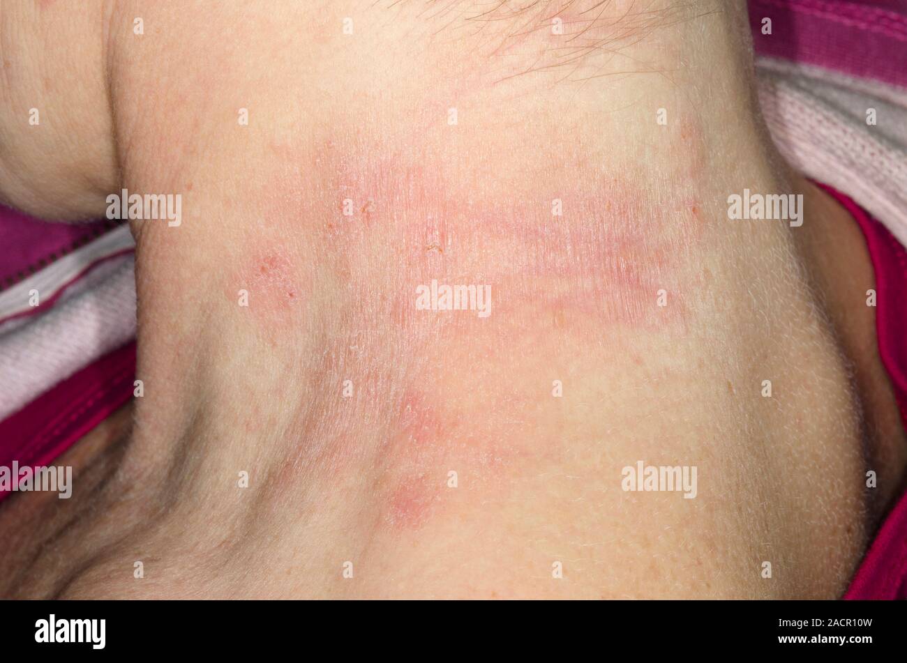 Rosso e traballante pelle sul collo di un 48 anno vecchio paziente femmina  con la dermatite