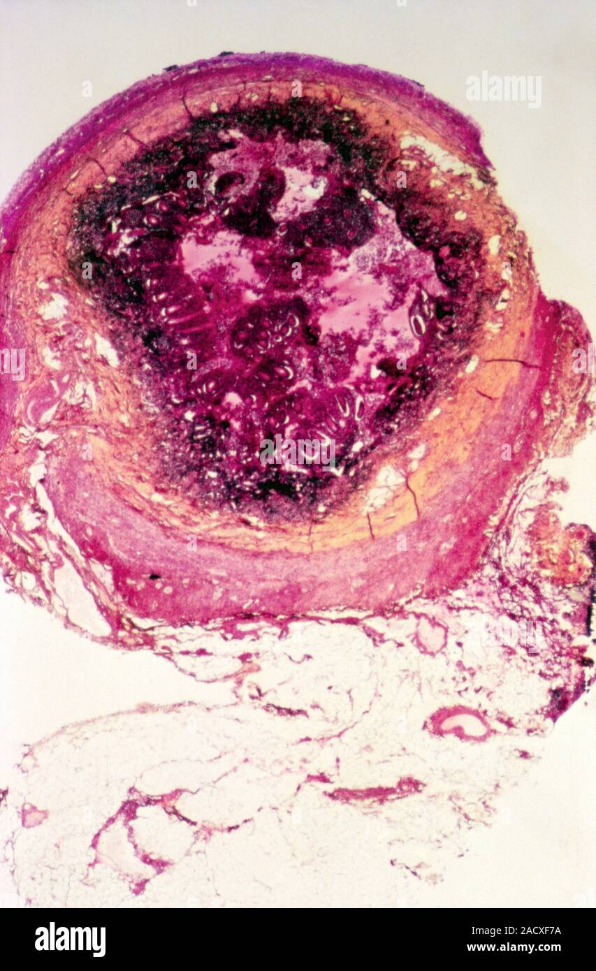 Appendicite. Micrografia di luce di una sezione di un appendice con appendicite acuta. L'appendice è una piccola sacca residuale collegato al grande in Foto Stock