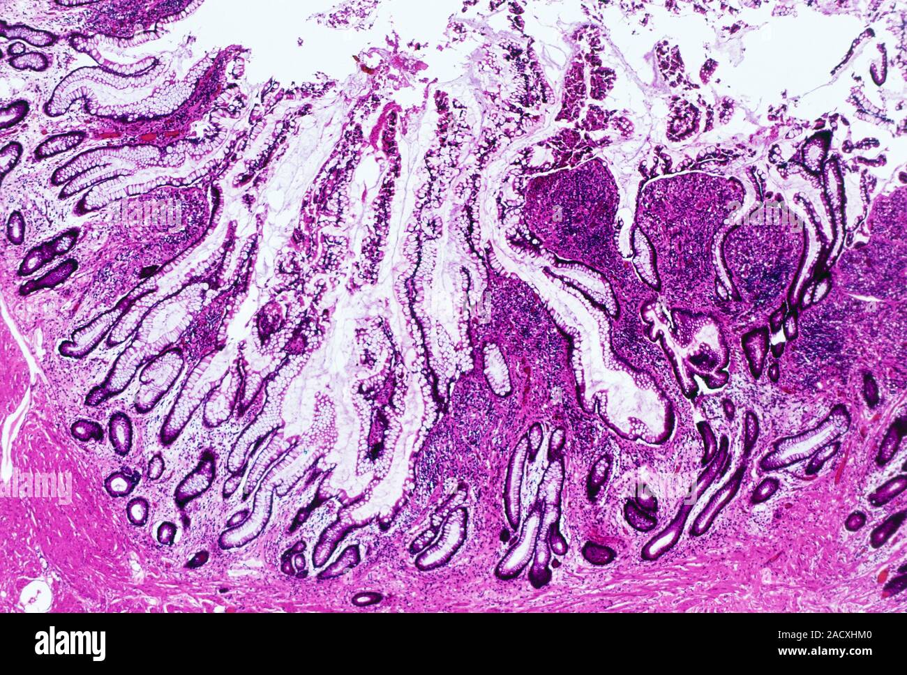 Il morbo di Crohn. Micrografia di luce di una sezione di tessuto