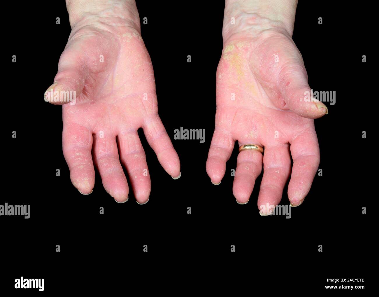 Artrite psoriasica su un paziente con le mani in mano. Artrite psoriasica avviene in una piccola minoranza di pazienti affetti da psoriasi, una malattia cronica malattia della pelle Foto Stock