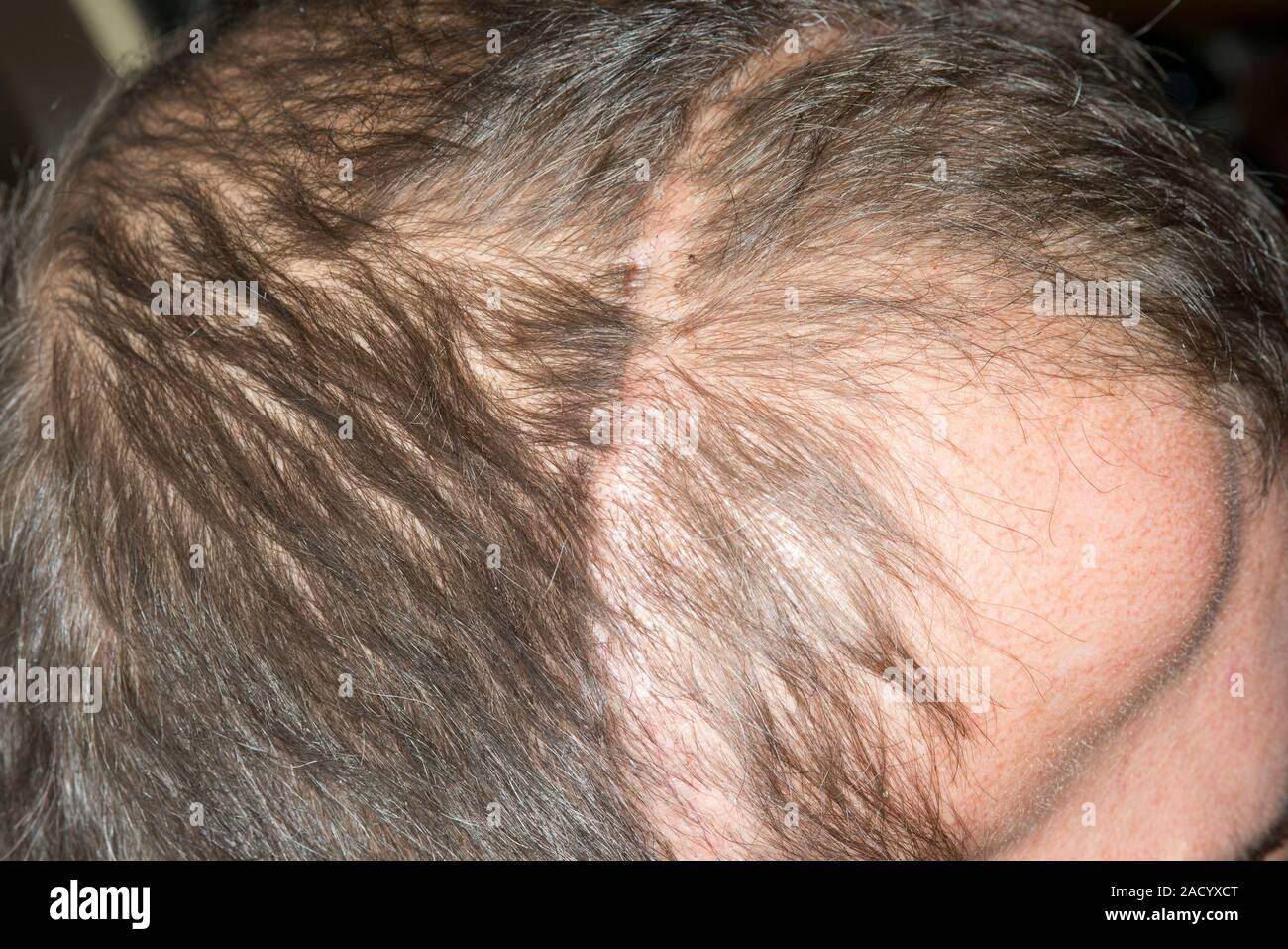 La cicatrice chirurgica sul cuoio capelluto. Close-up della testa di un  43-anno-vecchio paziente di sesso maschile con una cicatrice lasciata dopo  un intervento chirurgico per rimuovere un meningioma. Il meningioma si tumo
