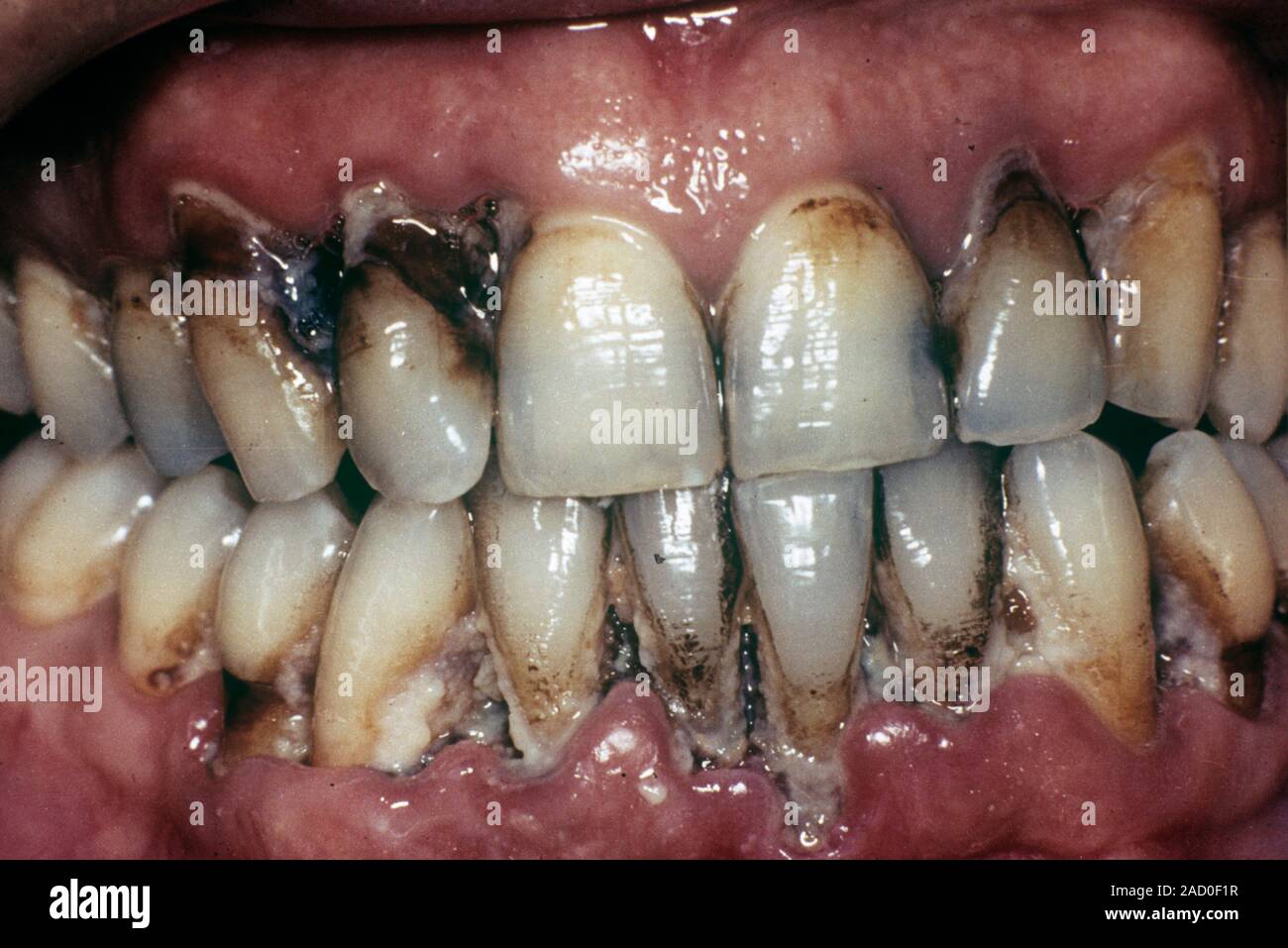 Il tartaro dentale, placca e malattie gengivali. Close-up dei denti di un paziente con la placca dentale e del tartaro, che ha causato la malattia parodontale (gengivite). Pla Foto Stock
